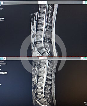 MRI lower back lumbar herniation herniated