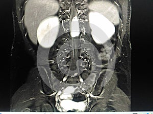 MRI Lumbar spine