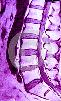 MRI of lumbar spine