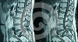 MRI Lumbar Spine