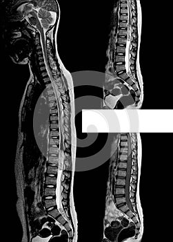 MRI Lumbar spine 3 views medical image.