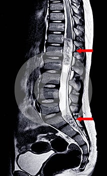 MRI Lumbar spine IMPRESSION:Intra-dural extramedullary mass at distal cord and conus medullaris, with tumor seedings at lower spin photo