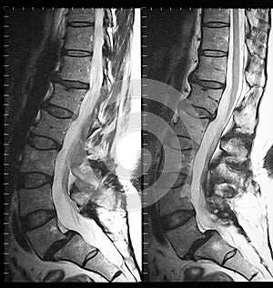 Mri of lumbar spine in sagittal plane