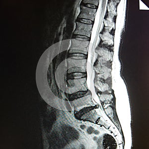 Mri of lumbar spine stenosis
