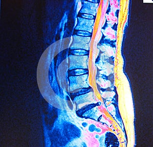 Mri of lumbar spine stenosis