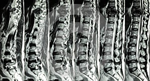 MRI of Lumbar & Thoracic spine : show fracture of thoracic spine and compress spinal cord ( Myelopathy )