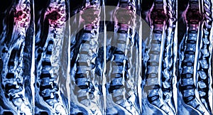 MRI of Lumbar & Thoracic spine : show fracture of thoracic spine and compress spinal cord ( Myelopathy )