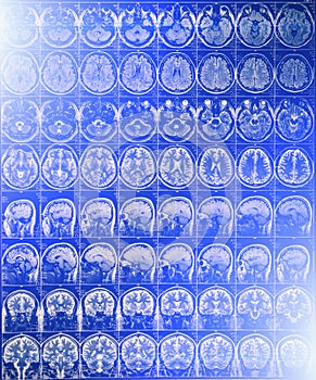 MRI or magnetic resonance image of head and brain scan with blue light effect