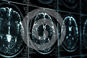 MRI or magnetic resonance image of head and brain scan. Close up view