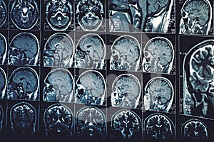 MRI or magnetic resonance image of head or scull and brain scan