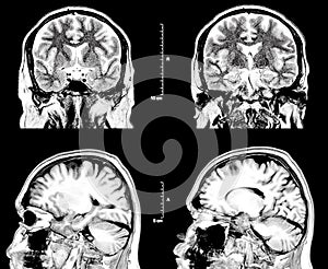 MRI Magnetic resonance image of the human brain and head