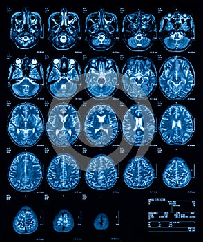 MRI (Magnetic resonance imaging) of the brain, transvers view, T2.