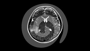 Mri and mrv of the brain: history a case presented with weakness and dysarthria, to rule out stroke.