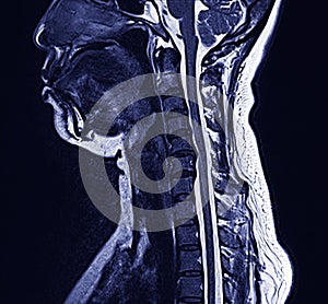 MRI neck