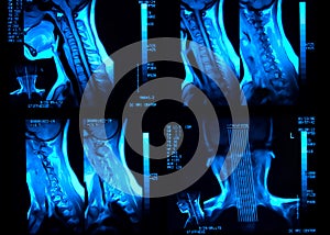 MRI neck scan