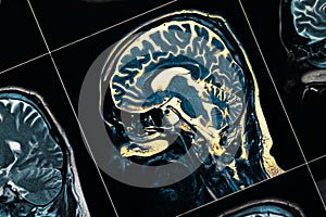 MRI of the patient`s head close-up. One picture from the series