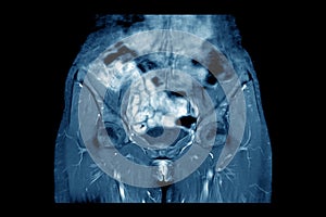 MRI Pelvic of a Healthy Woman finding Abnormalities like mass lumps.Medical healthcare concept