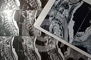 MRI Pictures of spinal column with magnification on overlaying t