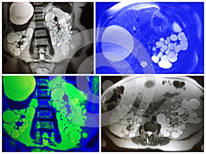 Mri polycystic kidney numerous hepatic cysts photo