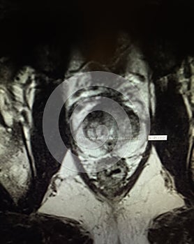 Mri prostate benign hyperplasia photo