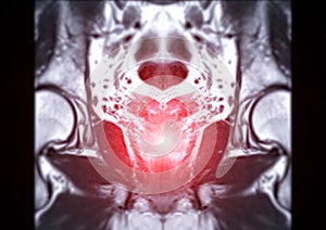 MRI of the prostate gland reveals Focal abnormal SI lesion at left PZpl at apex as described; PI-RADS category 4, clinically