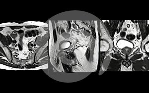 MRI of the prostate gland reveals Focal abnormal SI lesion at left PZpl at apex as described; PI-RADS category 4, clinically photo