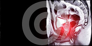 MRI of the prostate gland reveals Focal abnormal SI lesion at left PZpl at apex as described; PI-RADS category 4, clinically photo