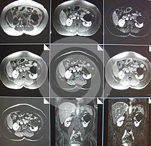 Mri of kidney cyst photo