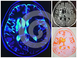 Mri right cerebral artery area infarct collage