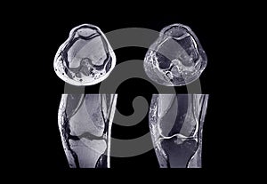 MRI knee joint or Magnetic resonance imaging .