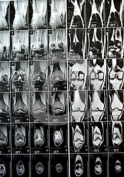 MRI of the right knee showing mild joint effusion, with normal other findings of PHMM, ACL, MCL, LCL, LM, ligaments, patella,