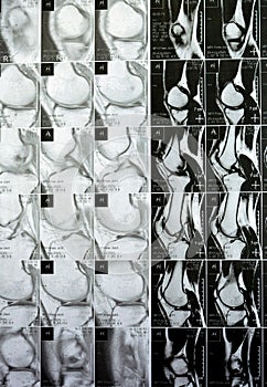 MRI of the right knee showing mild joint effusion, with normal other findings of PHMM, ACL, MCL, LCL, LM, ligaments, patella,