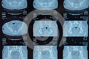 MRI sacroiliac articulation. Study of ankylosing spondyloarthritis patient