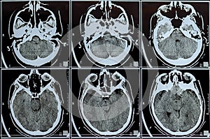 MRI scan of the brain