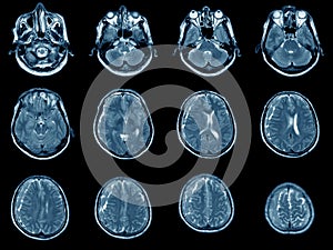 MRI scan of brain