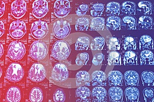 MRI scan of the brain for diagnosis. Medical examination for health prevention. Tomography shot. Close up of a CT scan with brain