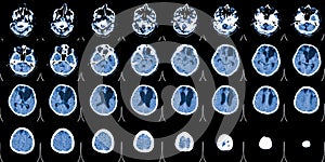 MRI scan of the brain. Magnetic resonance imaging scan. Medicine, science and education CT background