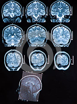 Mri Brain Scan