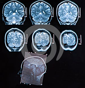 Mri Brain Scan