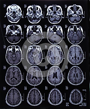 MRI scan image of brain