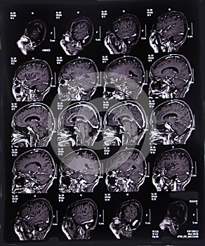 MRI scan image of brain