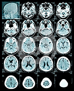 MRI scan image of brain.