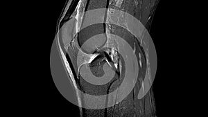 MRI Scan of left knee with ligament rupture