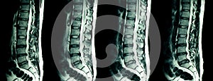 MRI scan of lumbar spines of a patient with chronic back pain