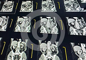 MRI scan of lumbosacral LS spine, coronal view, case of lumbar spondylosis and osteoporotic vertebral compression fractures