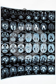 MRI scan or magnetic resonance image of the brain showed obstructive triventricular hydrocephalus. Medical service