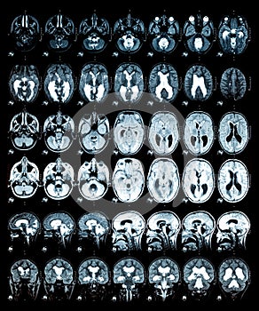 MRI scan or magnetic resonance image of the brain showed obstructive triventricular hydrocephalus. Medical service concept