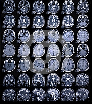 MRI scan or magnetic resonance image of head and brain scan