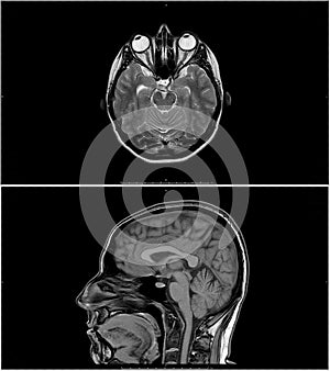 MRI scan or magnetic resonance image of head. Problems with the brain stem and pituitary gland.