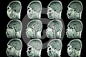 MRI scan of patient brain photo